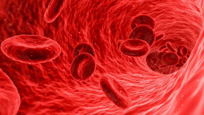 sarepol-anemia